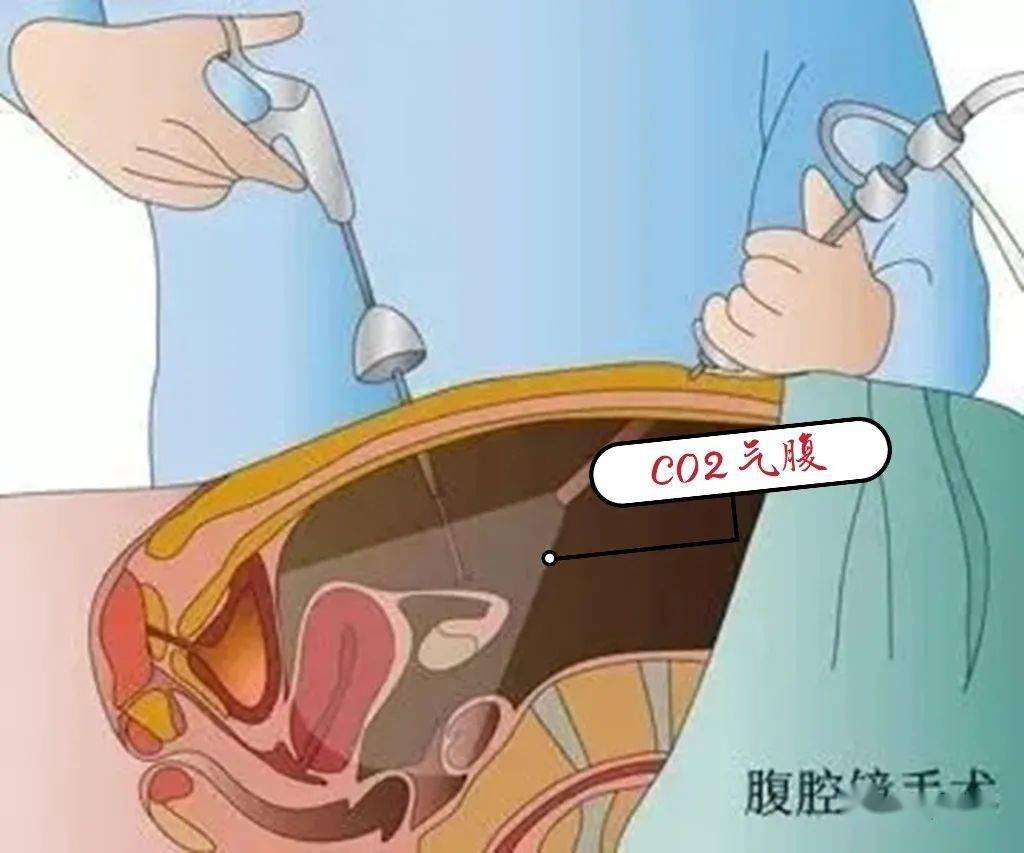 膽囊結石的健康宣教