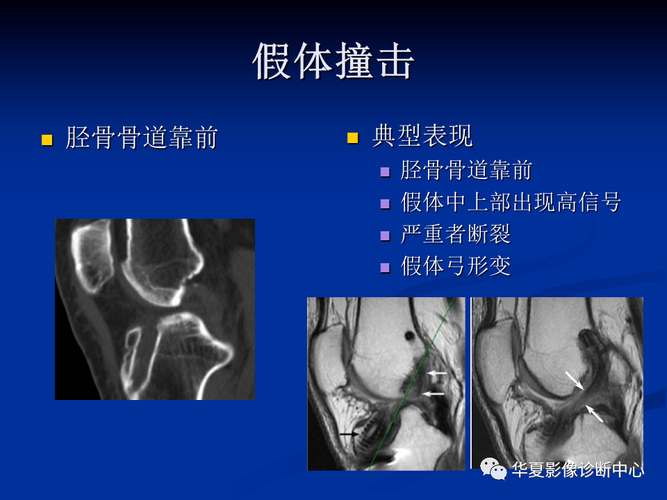 前交叉韧带单束重建后的影像评价