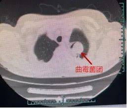 抵抗力|肺发霉？！杭州女子反复咳嗽10多年，医生从肺里“挖”出“臭鸡蛋”