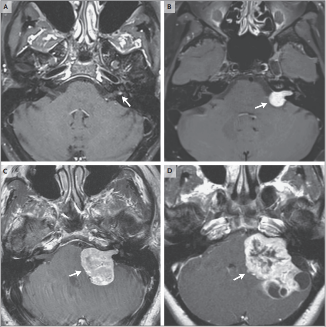 聽神經瘤臨床診療進展綜述2021醫學頂刊發佈