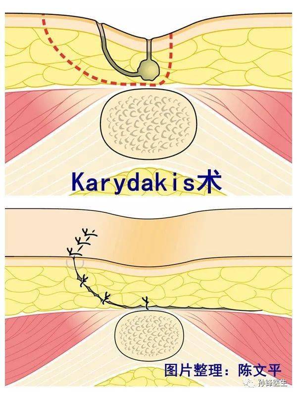 医学课堂藏毛窦也可以变癌