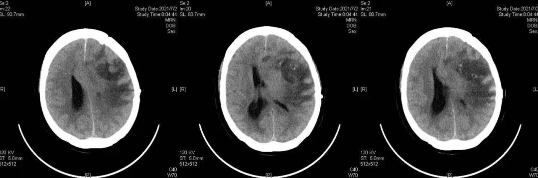 阔然开朗高文昌副教授团队胶质母细胞瘤1例诊疗分享