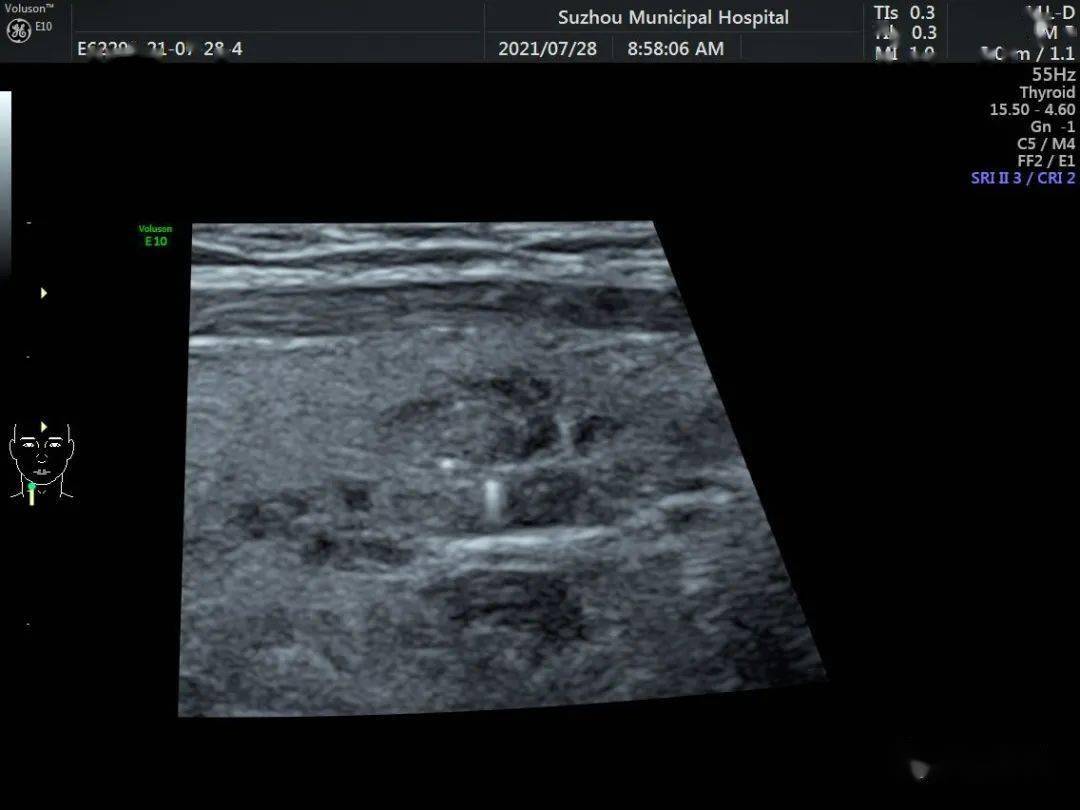 77甲状腺内大部分为良性病变,有点状强回声伴彗星尾征,但是也有少数