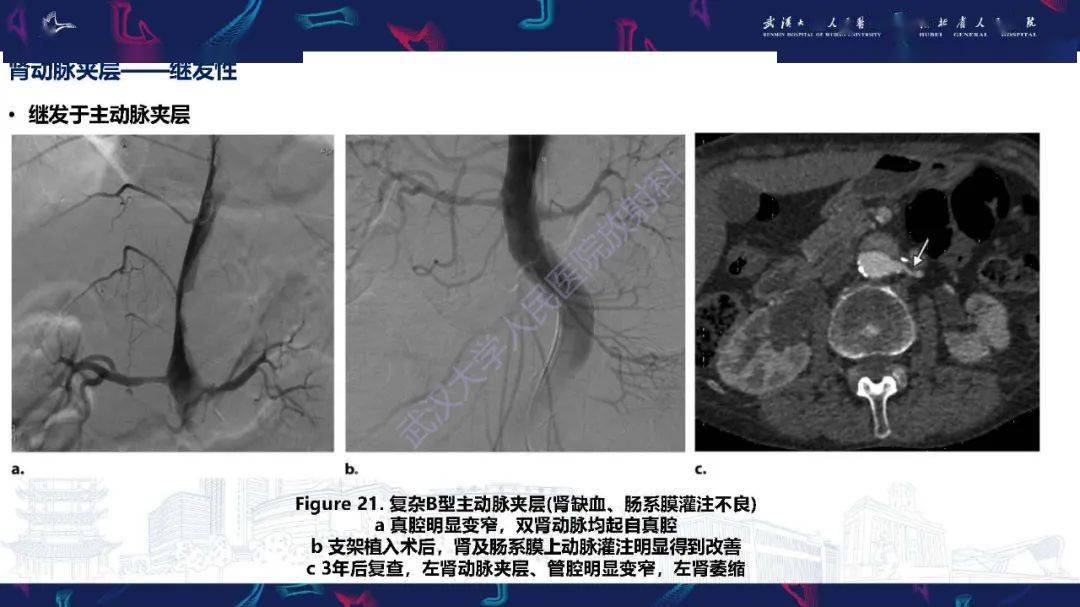 腎動脈解剖病理及血管內治療