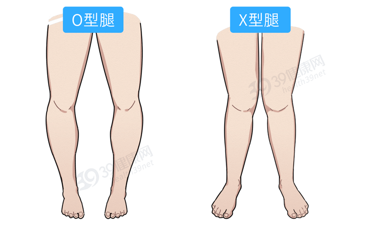 出现o型腿,x型腿走路比较晚1,出现x型腿,o型腿就千万要注意了!