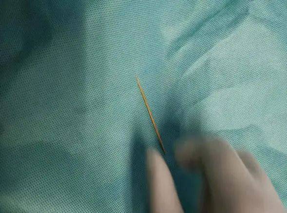 腹腔镜|小伙含着牙签喝水，一不小心吞进肚里致胃穿孔