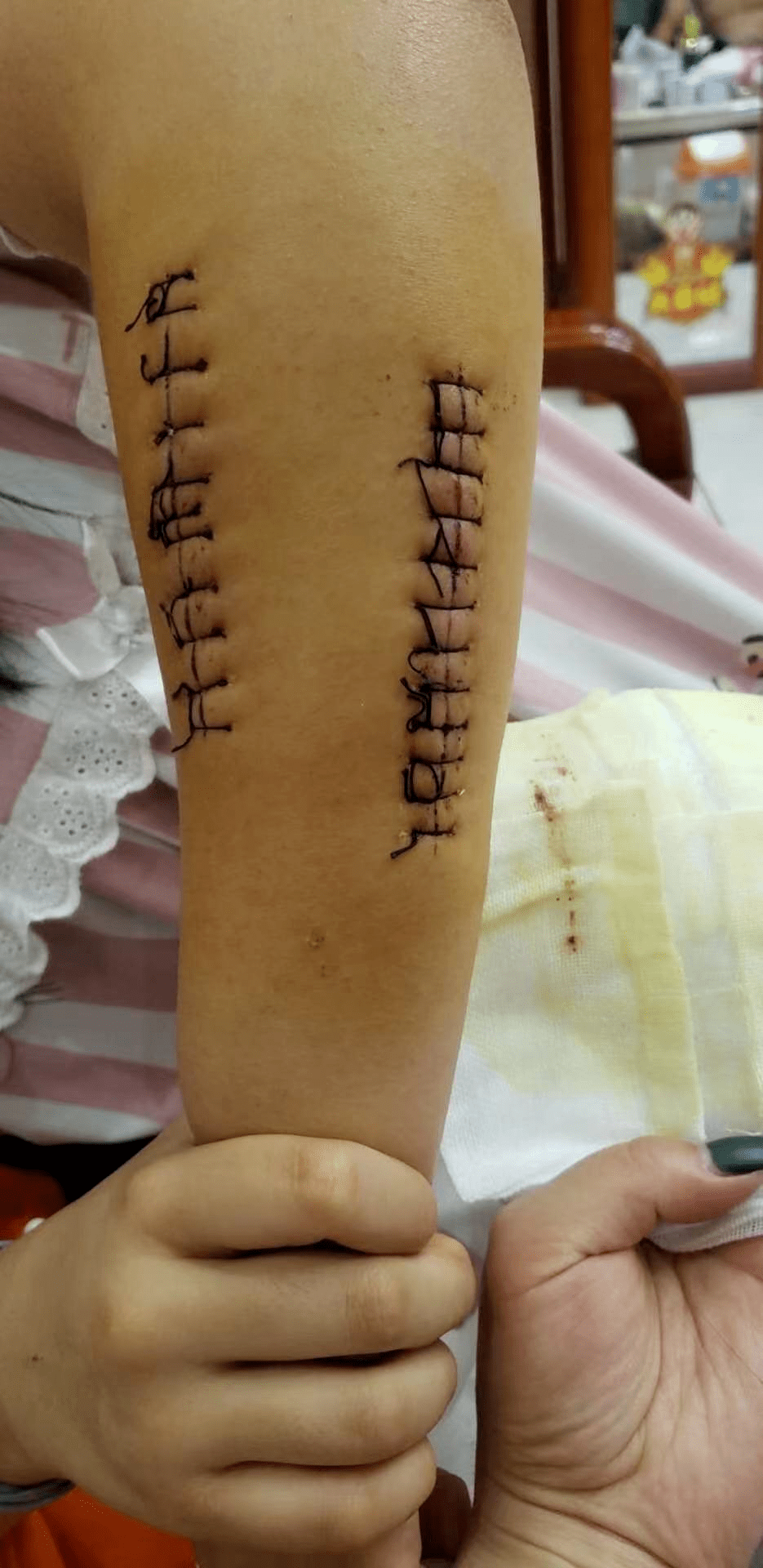 原平北方现代双语学校一学生校内摔伤骨折缝25针