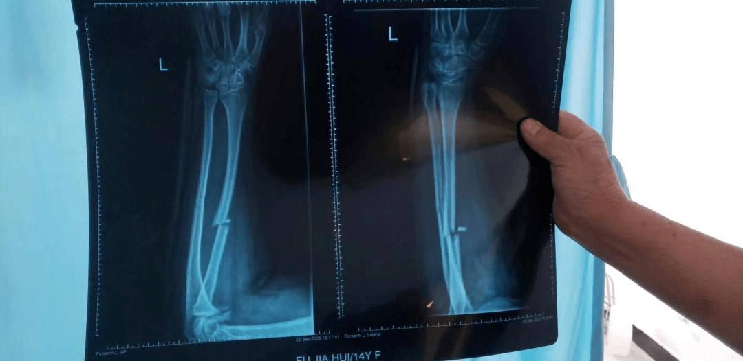 原平北方现代双语学校一学生校内摔伤骨折缝25针