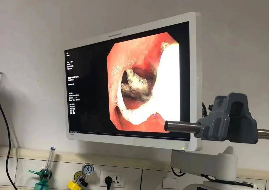 冷报|消失的假牙钩在气管上，老人“心肺都要咳出来”！这些动作不要做