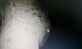 部位|这事儿真不能做！阿婆在家自己扎针灸，结果针断进腹中