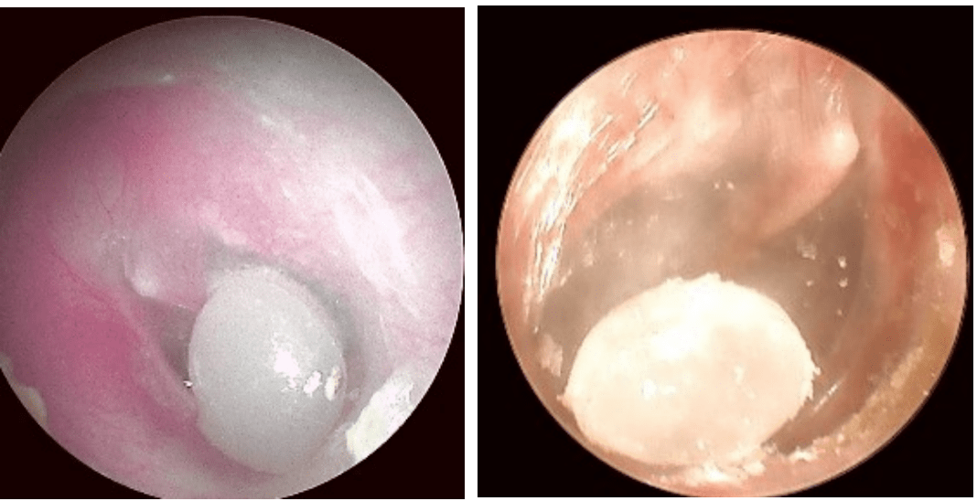 孩子耳朵进异物了,医生提醒要这么做_外耳道