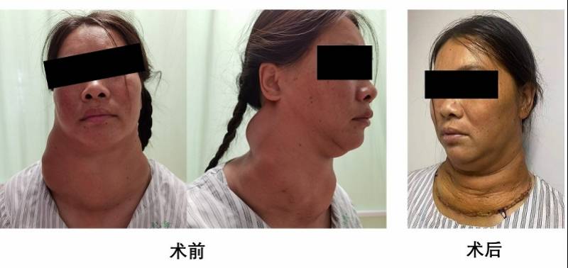 颈部|小肿块“绕颈”生长30年成巨大癌肿，连克难关将其完整切除