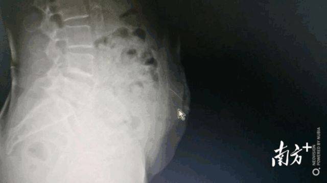 潘裕国|67岁阿婆自行针灸，却针断腹中！医生：擅自针灸有风险