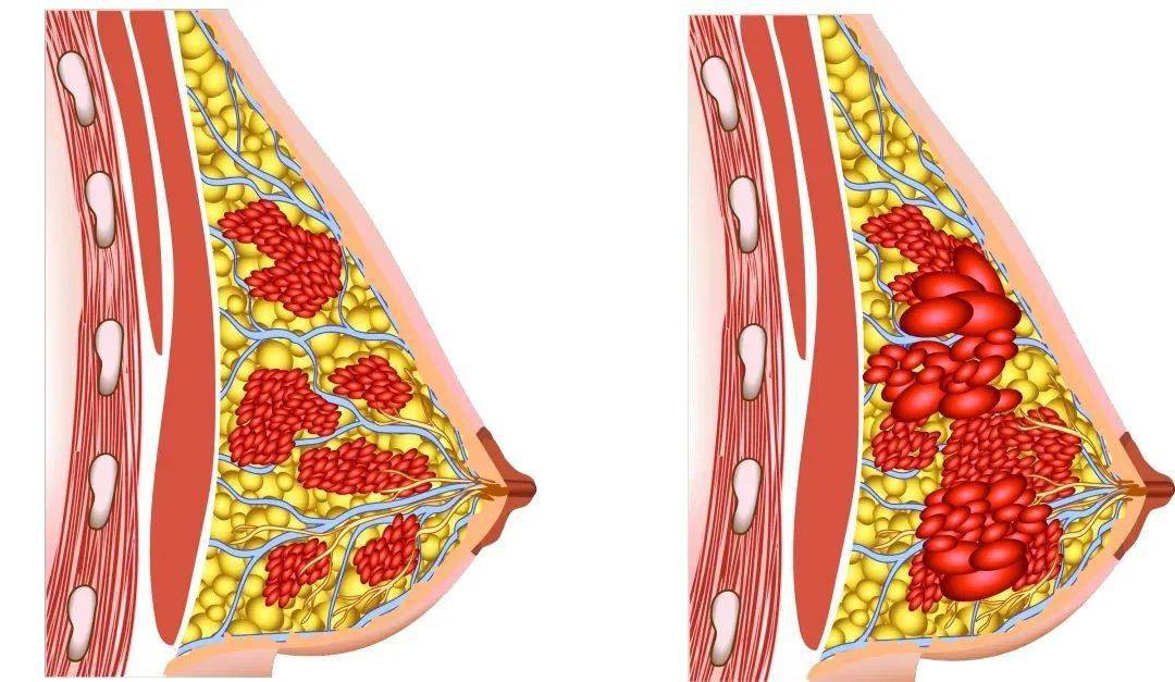 乳腺增生的位置图片图片