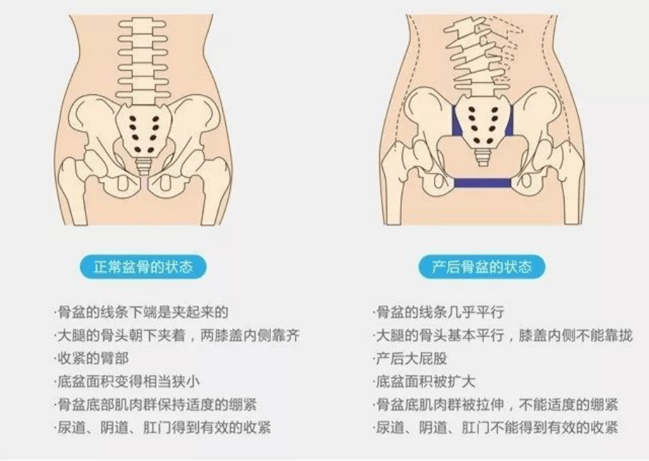 骨盆分离试验示意图图片