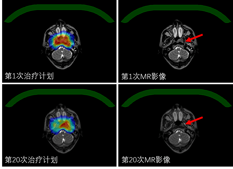 影像制定自適應治療計劃