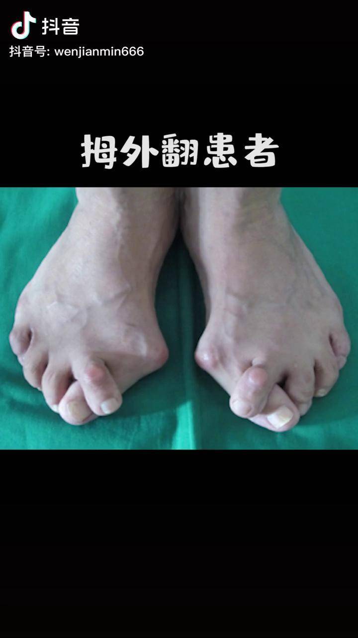 很多人对拇外翻不当回事不去zl拇外翻长期发展下去但是后果还是很严重