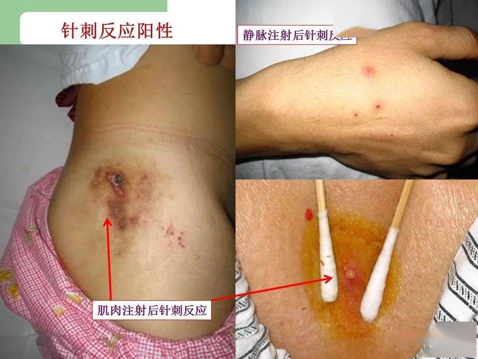 警惕白塞病临床各学科常见的20个陷阱