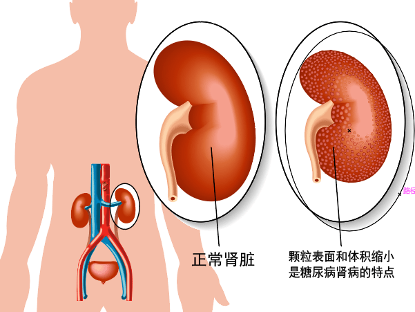 预测糖尿病肾病风险,扫码来测!