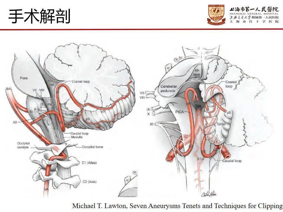 病例分享上海市第一人民医院苗宏生团队一例破裂小脑后下动脉瘤的手术