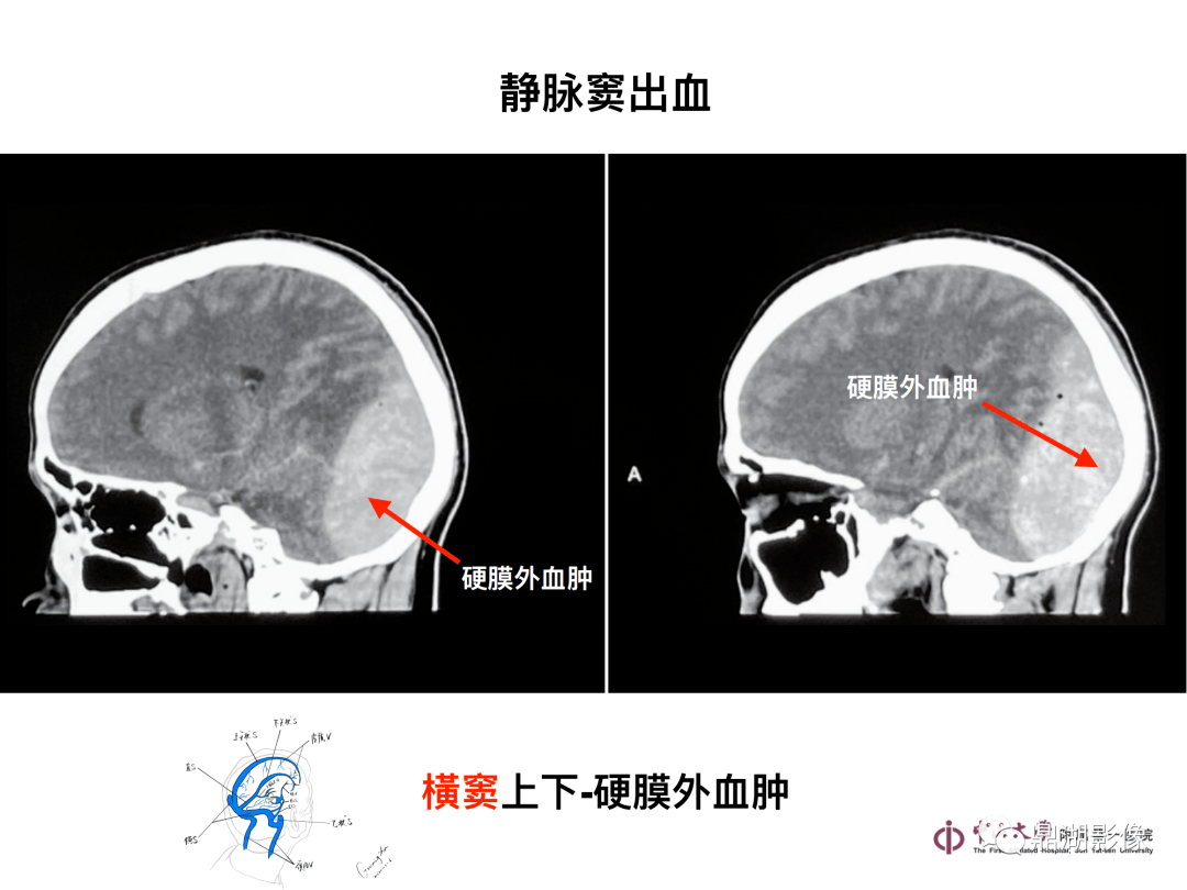 头颅CT片子图片