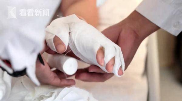 关节|常吃麻辣烫喝甜饮 19岁小伙全身遍布15处“痛风石”