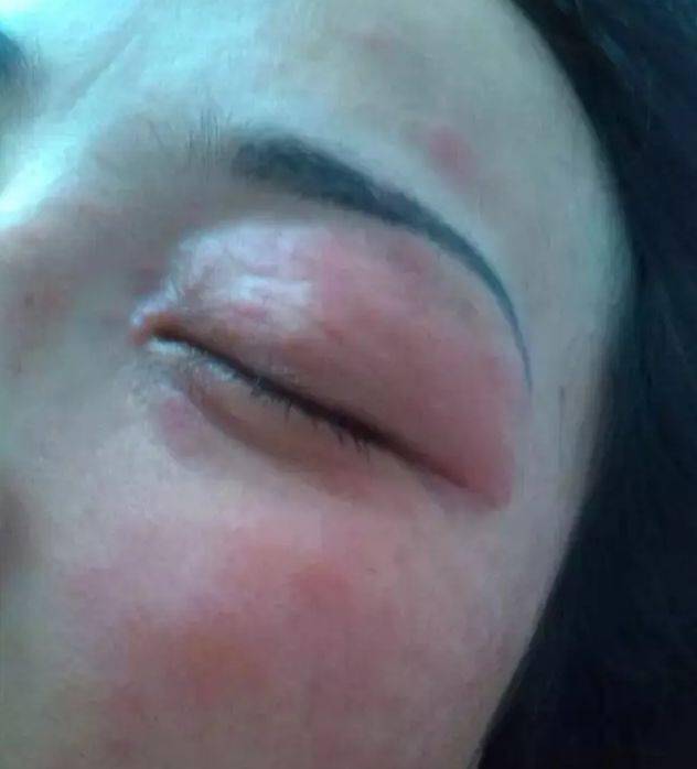 最全皮肤过敏处理方法!