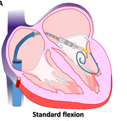 团队|毫米级伤口为心脏换“门闩”，广东团队经导管实施瓣中瓣置换