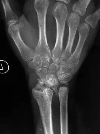 患者手术后x光片