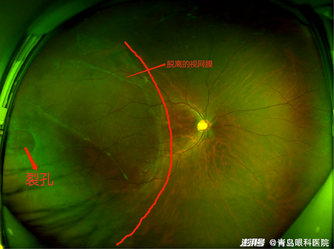 病例6-2-2 诊断:右眼黄斑裂孔，右眼底激光损伤。-血流OCT病例-医学