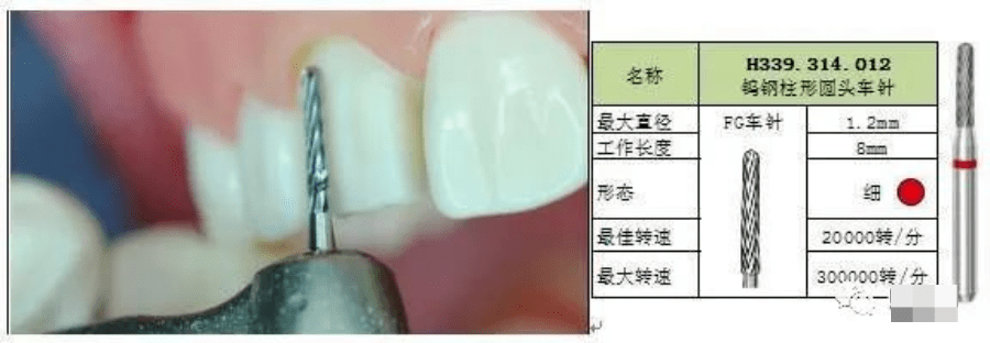 临床技能牙体预备全瓷冠标准化预备及车针使用技巧详解