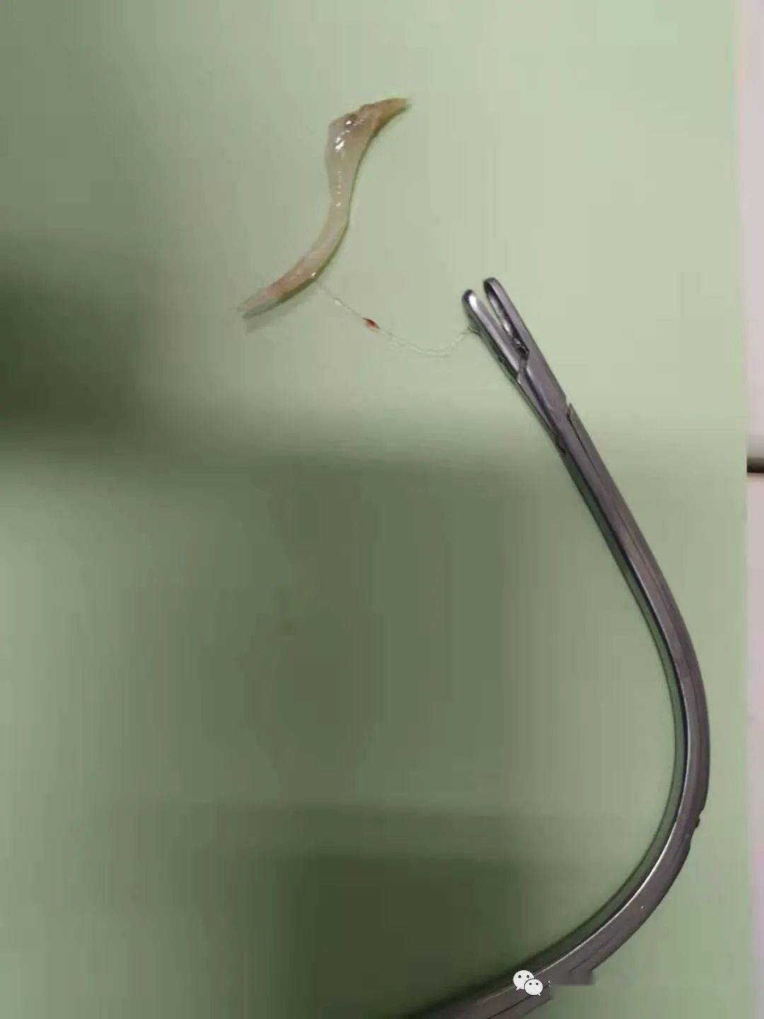 卡鱼刺喉镜图片