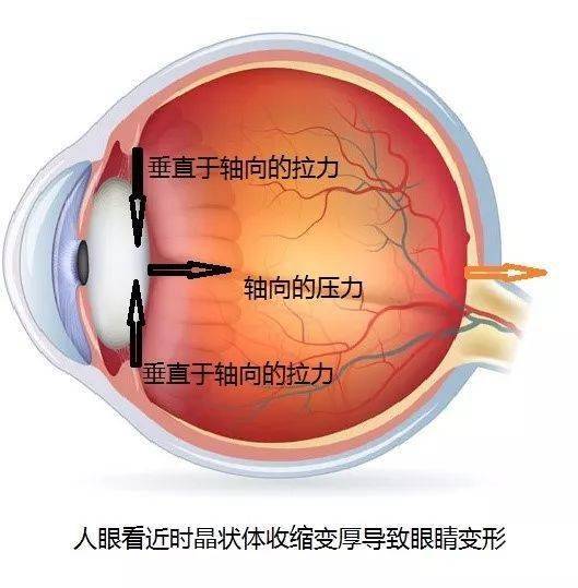 调节过度而引起辐辏作用加强,晶状体收缩变厚可以对眼睛产生两种力