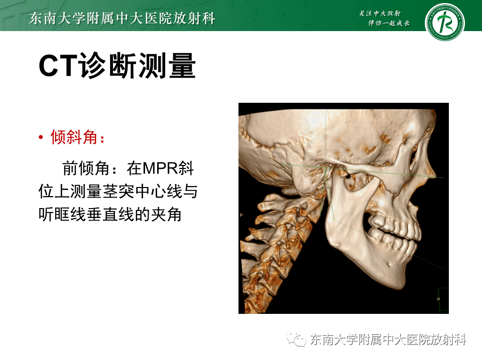 全面梳理:头颈部疾病——茎突综合征
