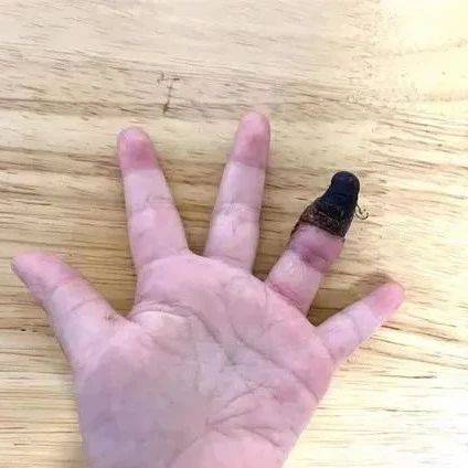 【警惕】奶奶一个动作,致3岁孙女手指坏死!_伤口