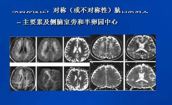 co中毒性腦病需與下列疾病進行鑑別:① 雙側多發性分水嶺腦梗死:形態