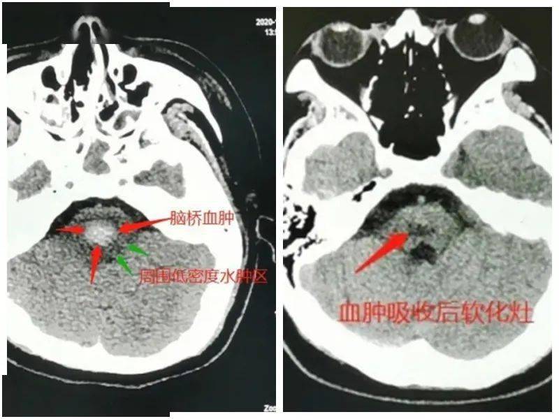 脑主干出血图片