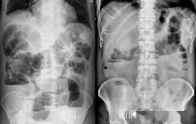 13 肠梗阻12 肠套叠11 腹股沟疝10 环状胰腺9 十二指肠闭锁8 肾破裂7