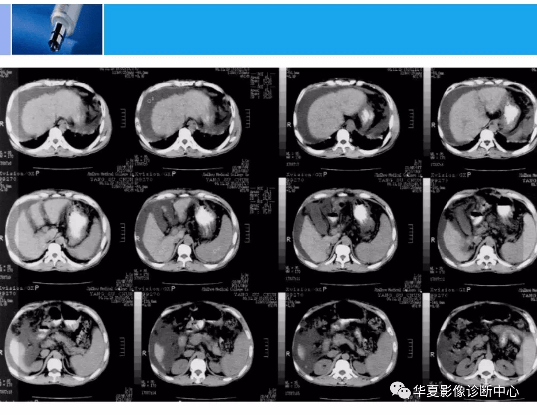 精華全篇肝臟的ct影像診斷
