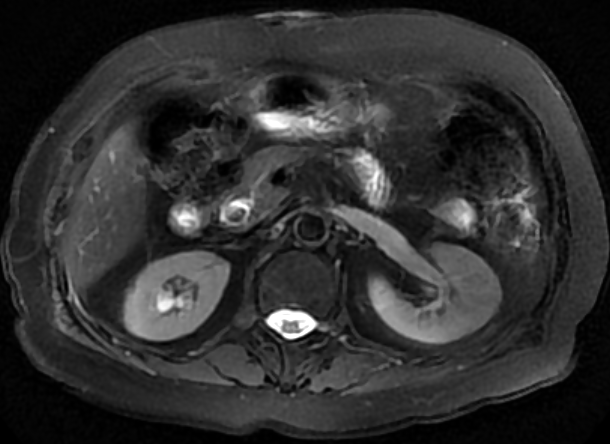 胆管结石患者核磁检查提示胆管末端存在结石
