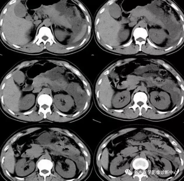 弹簧|图解21种腹部疼痛原因