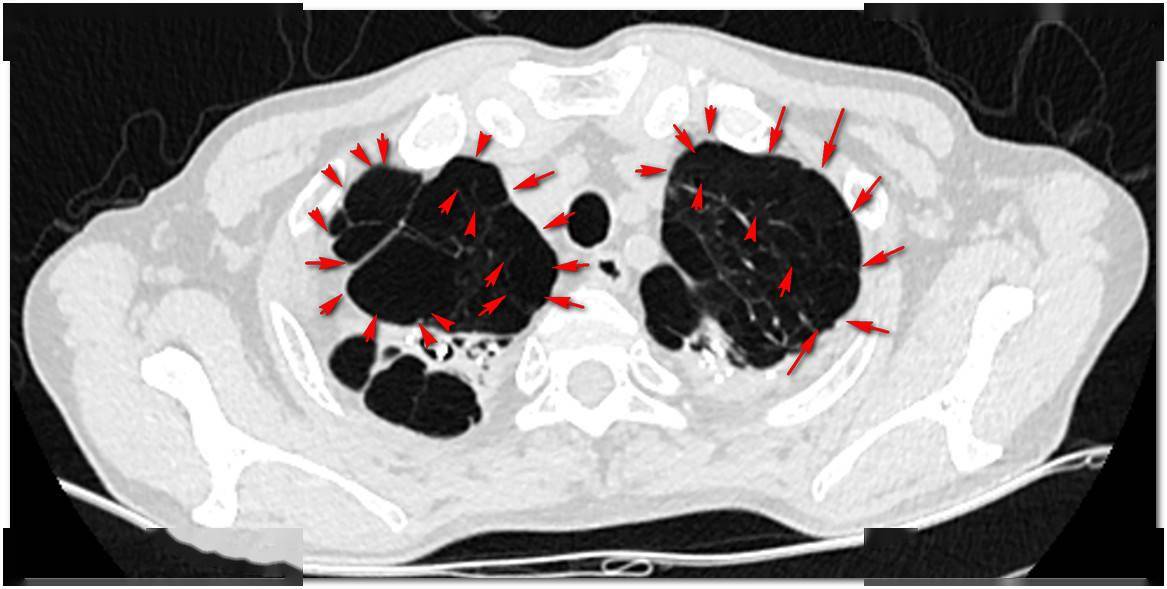 65岁老汉烂肺一年"炸"六次,上厕所再次破裂,胸部插管化险为夷
