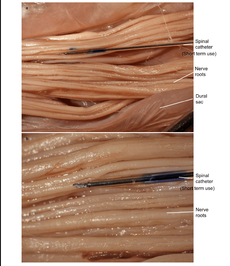 椎管內解剖及針頭的結構解讀