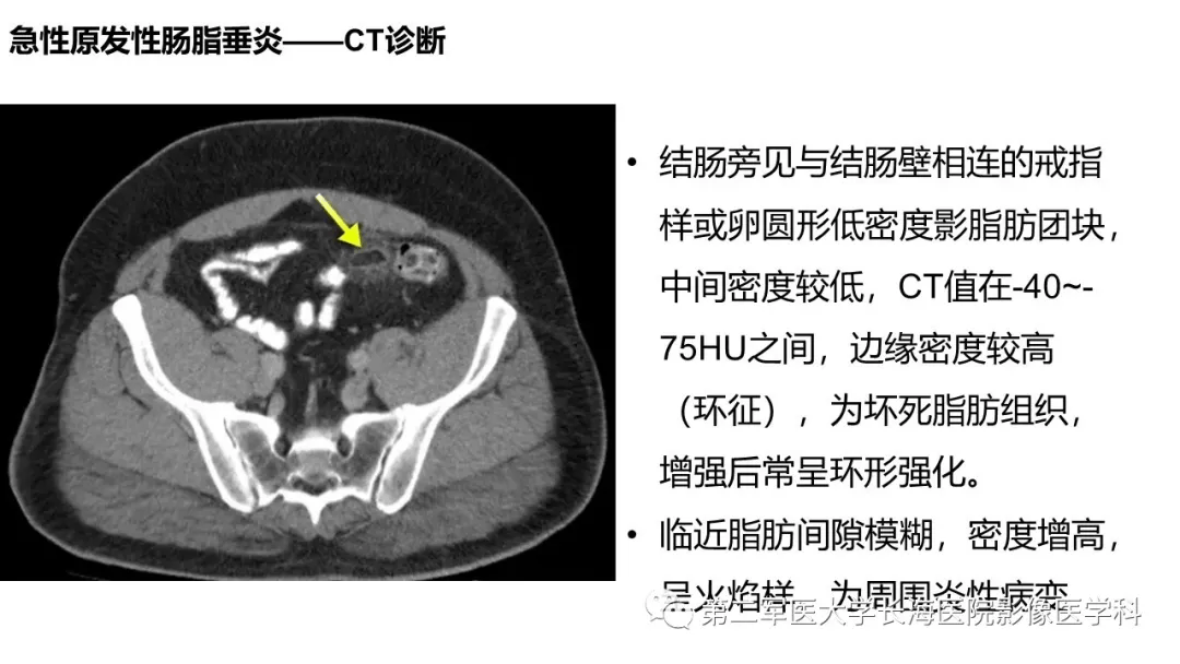 急性原发性肠脂垂炎ct诊断与鉴别诊断