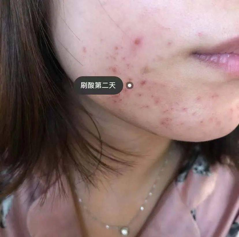 黑头|阿娇没骗我！2块钱敷一次酸，脸上“小疙瘩”竟被吞了！