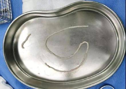 寄生虫|男子颈部长虫窝取出2条活虫 病因暂未查明！