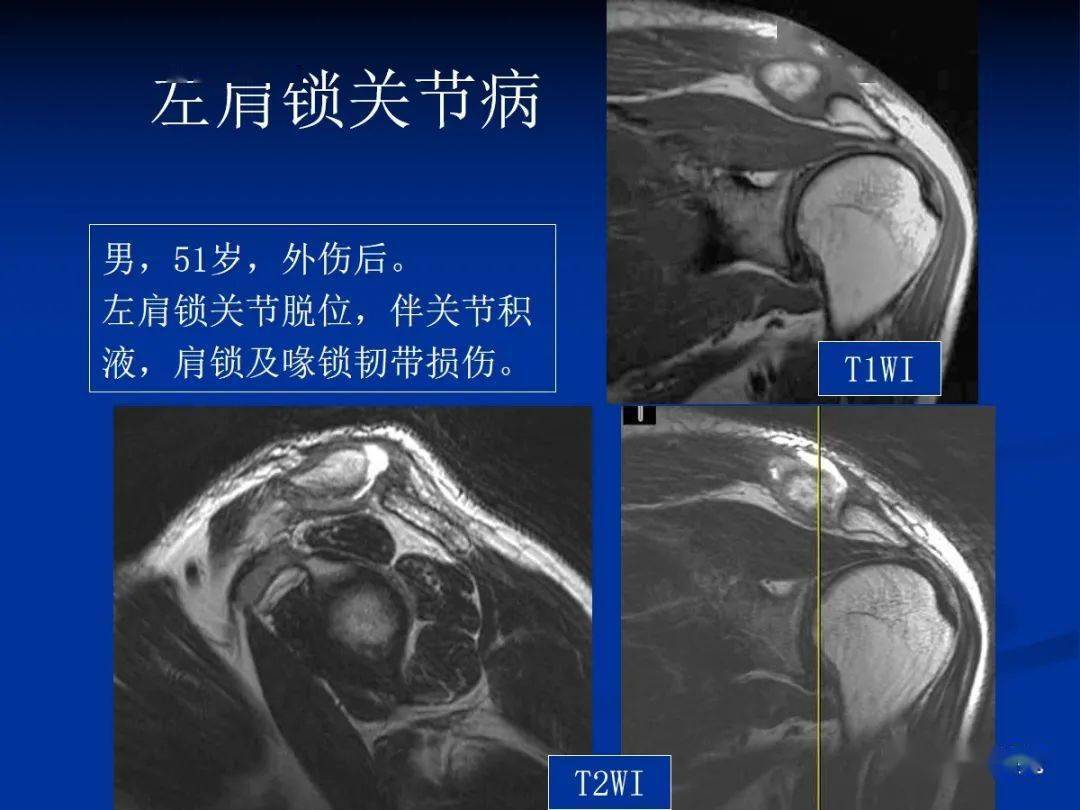 關節撞擊和肩袖撕裂高清圖解肩袖撕裂類型肩袖間隙的影像解剖及常見