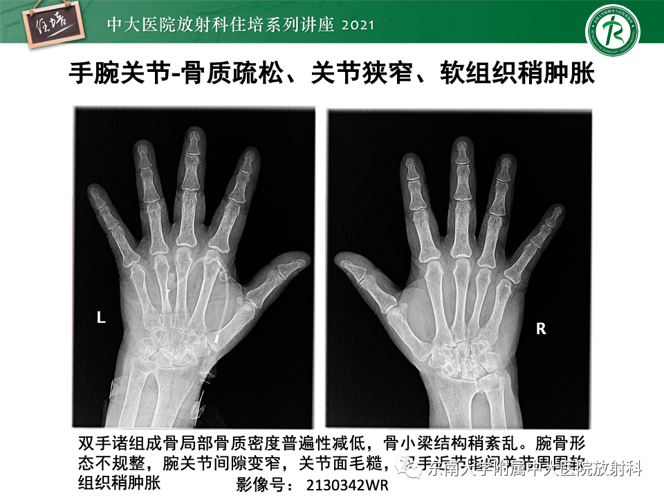 类风湿关节炎的影像学诊断