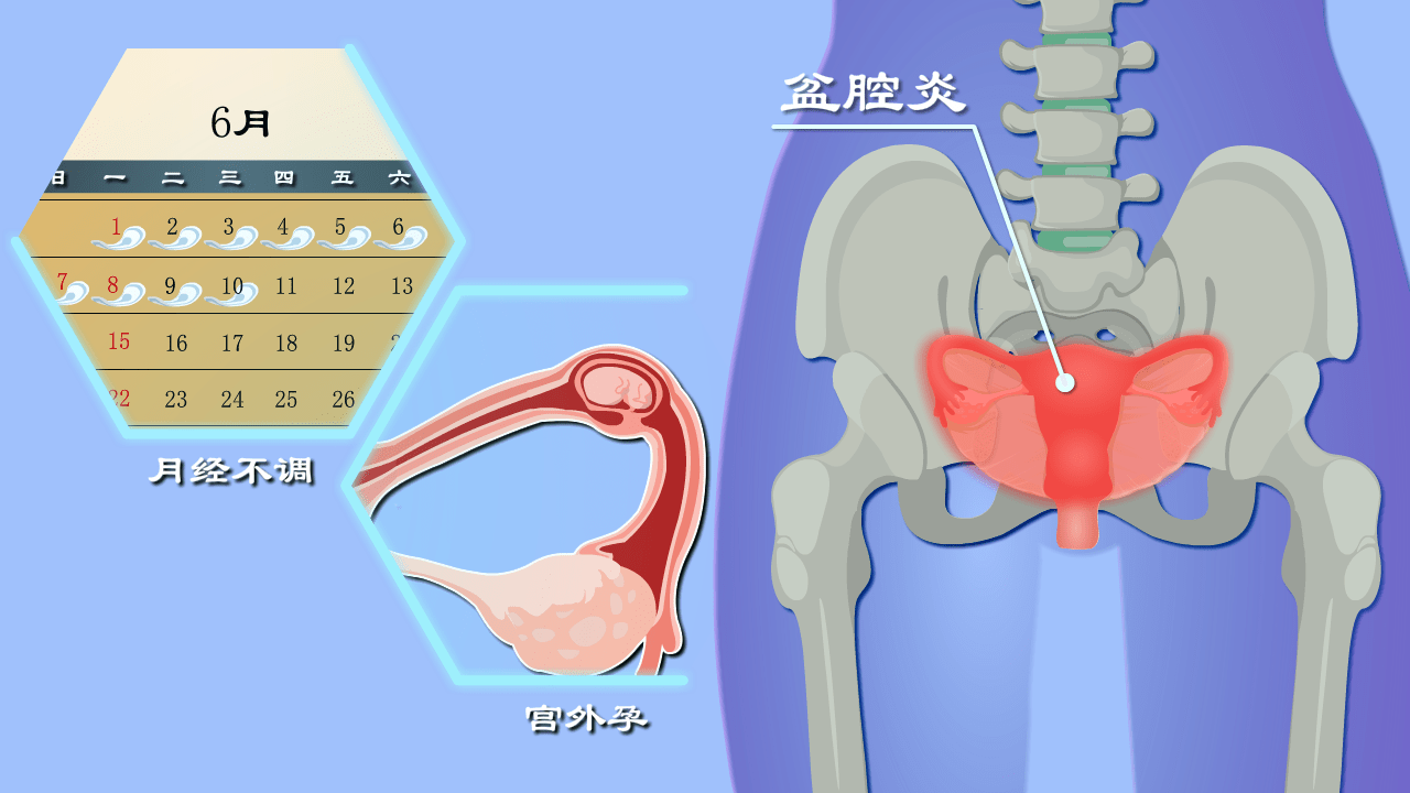 怀孕困难?会搞出宫外孕?盆腔炎危害有多大?硬核科普