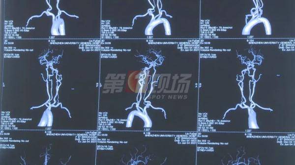 检查|全身换血！男子手脚“软趴趴”9年，在深圳找回了“力量”…